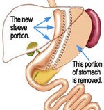 Top Ten Tips Before and After Gastric Sleeve Surgery