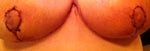 Horizontal Incision Line