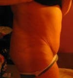 loose skin and muffin top after ETT