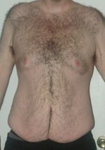 Any Where in Florida Central, South, Southwest for a $4000 Abdominoplasty? (photo)