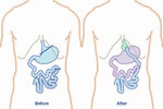 Weight Loss Surgery - What Is It?