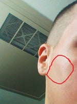 I have 2 brown spots post-op Fraxel Restore... what is this?