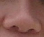 I had my nose job done in Asia, but really hate it. Need revision surgery.