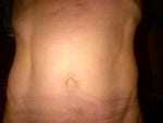 has anyone had mini tummy tuck and belly button done from underneath?