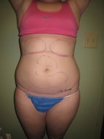 swelling and bruising?