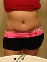 rippiling at the end of incision normal?