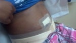 hi i had a tummy tuck done with musle repair on May 3 2012 i have alot of questions and if someone could give me feedback