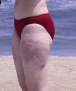 Cellulaze Bruising and Pain