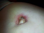 popped stitch on my belly button