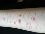 Getting rid of scars???