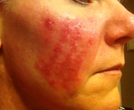 Day 8 post Fraxel Re:pair