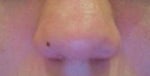 How will my boxy tip nose look like after surgery?