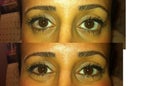 Lower eye lid muscle bulging