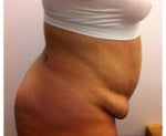 My Tummy Tuck is scheduled for July 9th, 2012