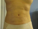 Dr. Recommendations for Liposuction Revision in Los Angeles?