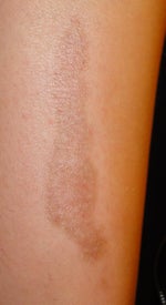 What would be the most effective treatment to lessen the size and dark color of a large flat scar on a shin?