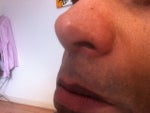 Columella Scar treatment