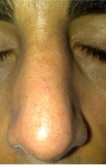 Will my nose look better than what it is now?