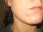 Doctor in the Milwaukee Area with Lots of Experience with Rolling and Depressed Acne Scars