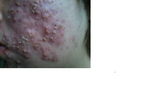 Accutane ruined me...