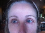 I am 7 weeks post op on a lower eyelid bleph.  My right eye still feels very tight and "drawn up" and I have a bit of skin that 