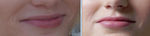 Will Injections Help These Smile Lines? I Am 24 Years Old.