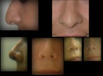 Rhinoplasty, A bit depressed with the outcome thus far...A bit of a pig-nose, upturned tip..Has the tip gone down for anyone?