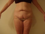Do I Really Need the Feur-de-lis TT or Will I Have Almost the Same Results with a Regular horizontal Hip-to-hip Incision?
