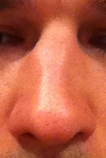 Advice on Rhinoplasty Surgeon in Europe