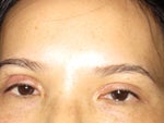 Anyone Has Complications after Eyelid Surgery????