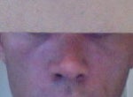 Help finding a board certified plastic surgeon very experienced with restylane for tear troughs in Colorado