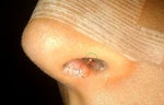 Small, Hard and White Bump Under the Stitch of Septoplasty?