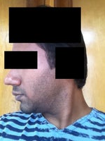 Nose skin improvement