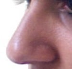 Where Can I Have a Middle Eastern Rhinoplasty Done in the New York City Area?