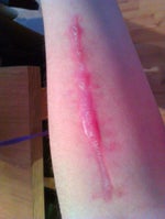 What can be done for a hypertrophic scar?