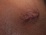 Lipoma Stitches photo , is it normal or infected ?