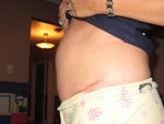 Upper abdomen failed muscle repair