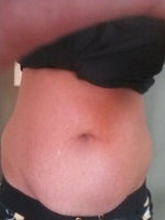 Hi Ladies! I am scheduled for TT and Lipo of the Flanks and Mons in two days!