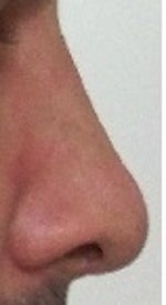Nose tip drop and nostril's height