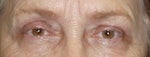 Too much eyelid exposed after upper blepharoplasty
