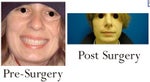 Correcting asymmetrical nostrils