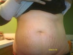 Am I a good candidate for a tummy tuck?