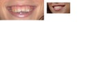 Veneers - do my teeth look fake?
