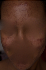 Palomar Fractional 1540 Laser for acne scars on dark skin?