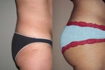 Butt Implants before and after photos