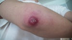 Best treatment for hypertrophic scar on my Elbow?
