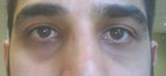 Best treatment for dark circles