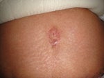 Why does my belly button look flat after tummy tuck?