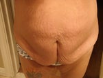Tummy tuck help area above belly button, too?