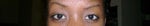 What procedure would help my uneven eyelids?